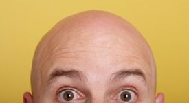 Каква е причината за мъжкото оплешивяване?