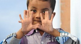 Арпан Саксена е 4-годишно индийче с ... 25 пръста на ръцете и краката