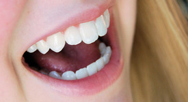 Вредно ли е избелването на зъби?