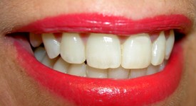 Зъбната плака се свързва с ранна смърт
